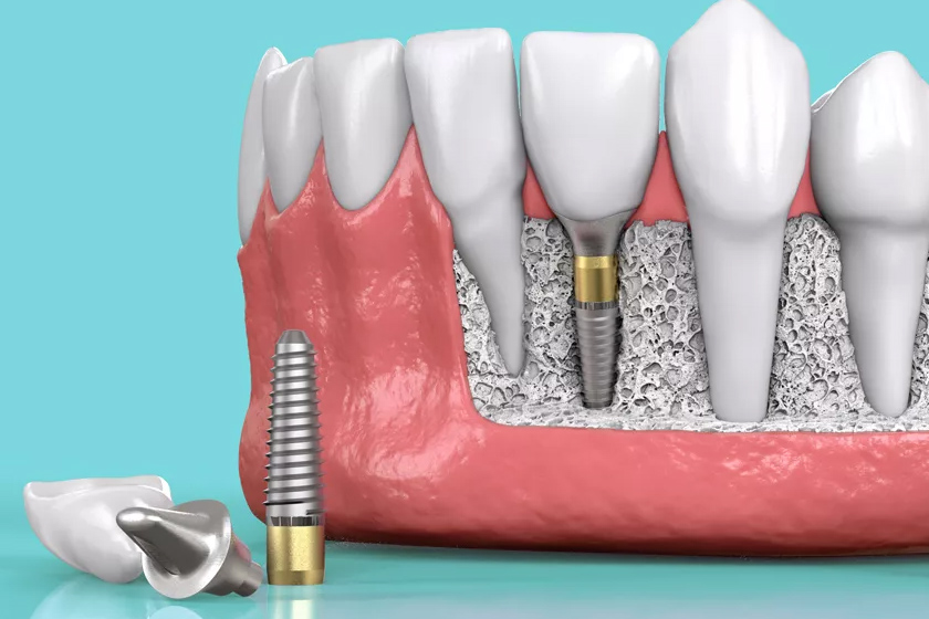 Американские зубные импланты: преимущества имплантов из США.