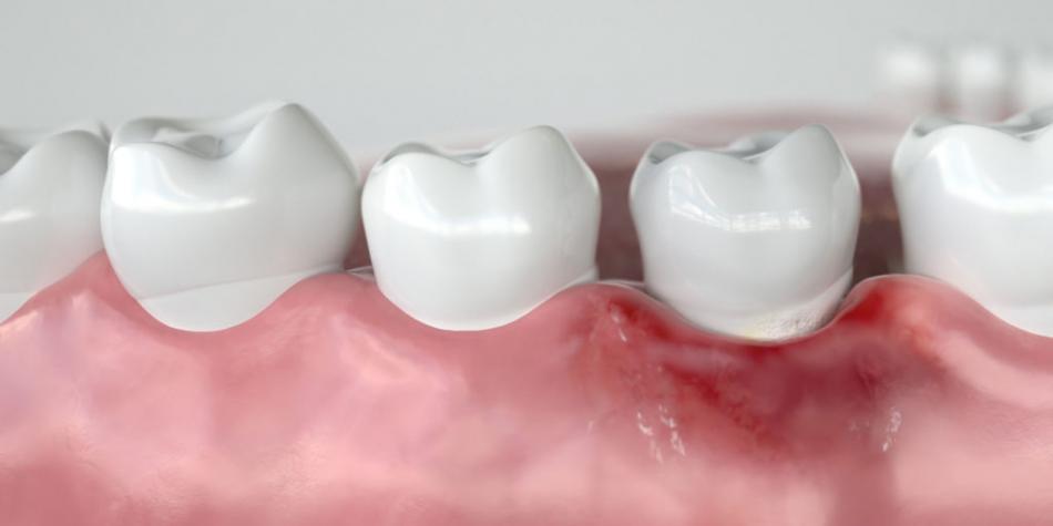 Что делать, если после удаления зуба опухла щека?