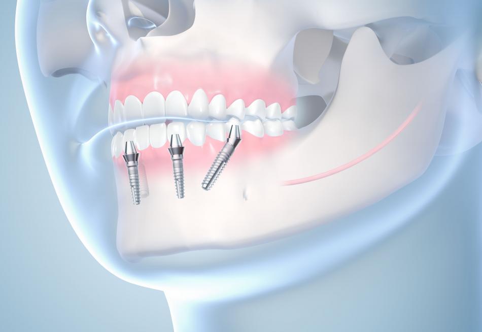 Имплантация зубов - современные протоколы