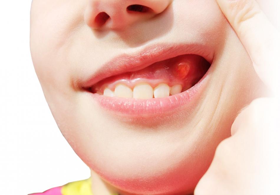 Свищ зуба - симптомы и причины заболевания.