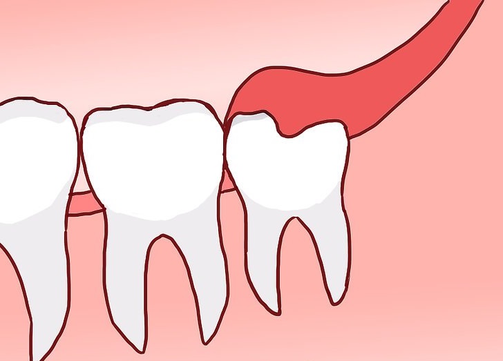 Почему опускается десна и оголяются корни зубов у взрослых и детей