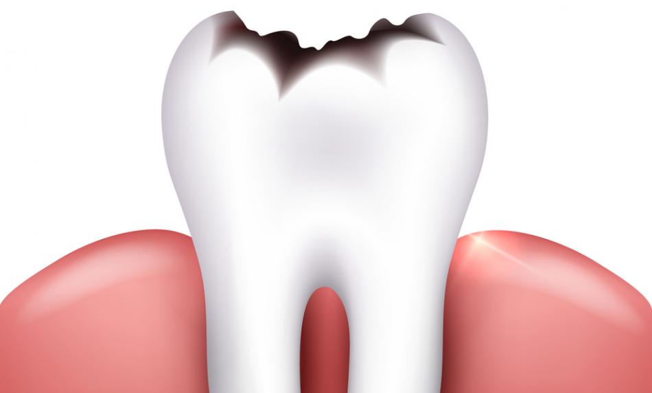Лечение зубов без сверления в самаре thumbnail